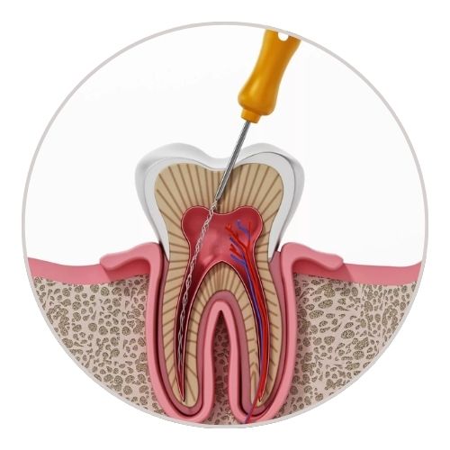 Root canal treatment Kolkata