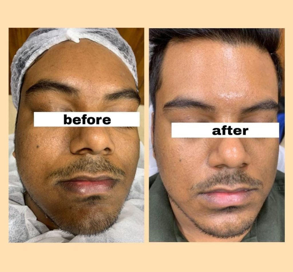 skin treatment in siliguri before after